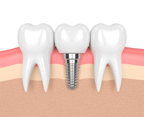 implantologia oral