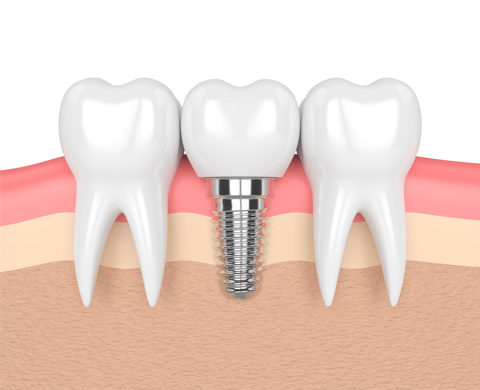 implantologia oral implantologia oral